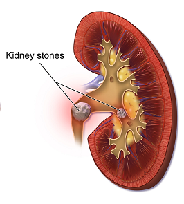 kidney stone